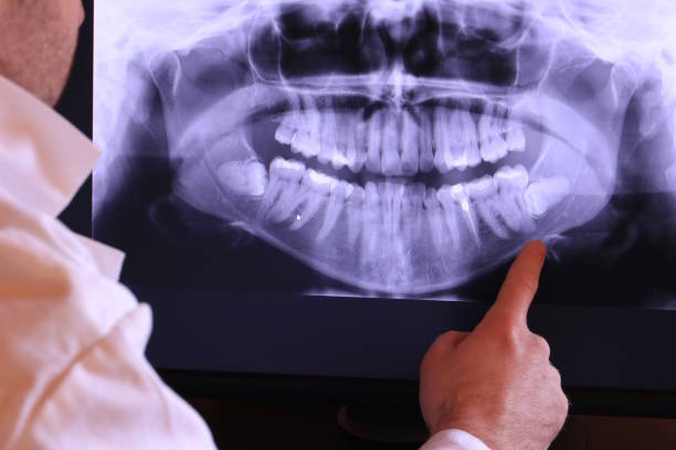 Best Emergency Dental Extractions in Camden, SC