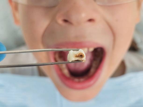 Best Emergency Dentist for Knocked-Out Tooth in Camden, SC